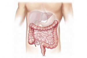 فاکتورهای مهم در ابتلای زودهنگام به سرطان روده چیست؟